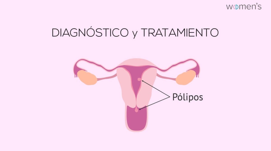 Pólipo endometrial ¿Que es? Diagnóstico y tratamiento